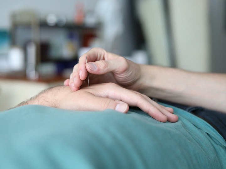 Acupuncture